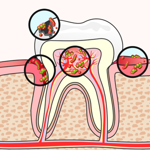 Tooth Section With Damage and Germs