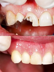 Before and After Dental Bonding