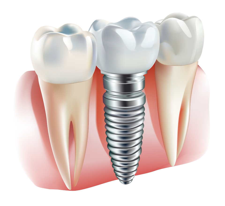 Dental Implant Restorations
