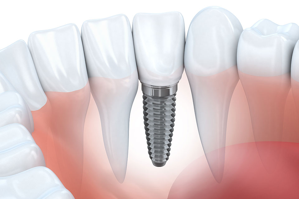 Dental Implants Dental Implants