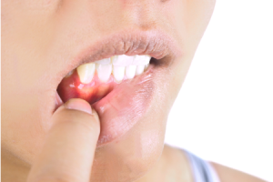 Gums Hurt with Periodontal Disease